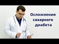 Неврологические осложнения сахарного диабета