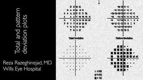 5-  Visual field interpretation (Total and pattern deviations in Humphrey perimeter)