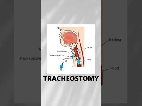 #tracheostomy #trachea #medical