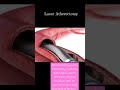 LASER ATHERECTOMY PROCEDURE Plaque Removal From Arteries Viral Shorts Atherectomy Medical LASER ATHERECTOMY PROCEDURE Plaque Removal From Arteries Viral Shorts Atherectomy Medical