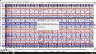 fMRI EEG Pulse Artifact Correction In BESA Research