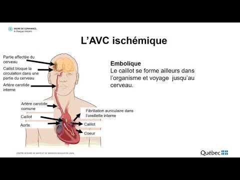 Vidéo: Intégrité De La Barrière Hémato-encéphalique Des Patients Ayant Subi Un AVC Se Présentant Dans Une Fenêtre De Temps étendue