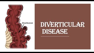 Diverticular disease/diverticulitis - pathogenesis, clinical feature, investigation, management