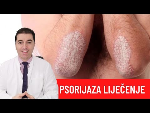 Video: 4 načina za prirodno liječenje psorijaze