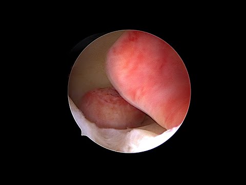 Video: Hysteroscopic Removal Of Endometrial Polyps