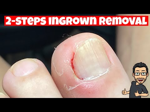 HOW TO REMOVE AN INGROWN TOENAIL