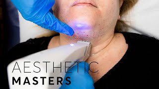 Non-Surgical Facelift - What is Profound RF?