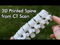3D Printed Spine from a CT Scan