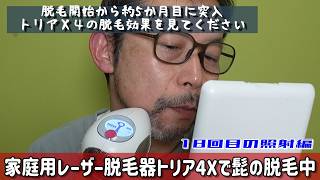 5 Months Since Starting Beard Removal with Tria X4: Checking