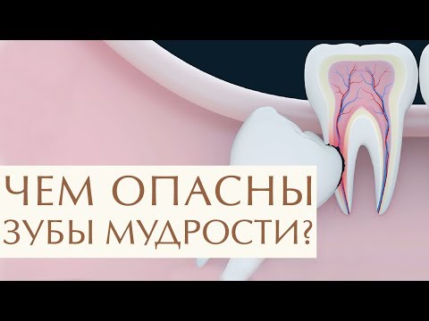 🤔 Для чего нужны зубы мудрости, стоит или нет их удалять. Удалять или нет зуб мудрости. 12+