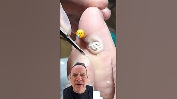 DOCTOR REACTS: AMAZING PLANTAR WART CURE! 😱 #shorts