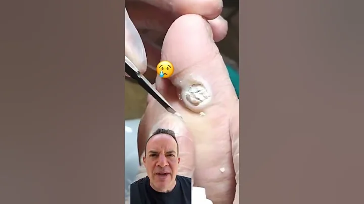 DOCTOR REACTS: AMAZING PLANTAR WART CURE! 😱 #shorts