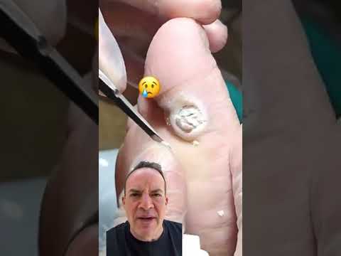 DOCTOR REACTS: AMAZING PLANTAR WART CURE! 😱 #shorts