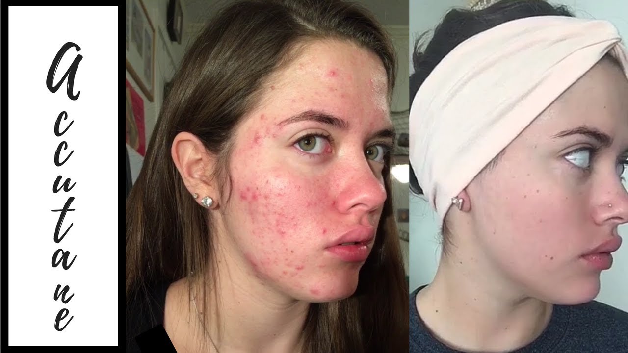 My Accutane Treatment Before And After Youtube
