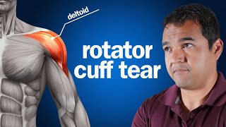 Should You Strengthen Your Deltoids to Help Heal a Torn Rotator Cuff?