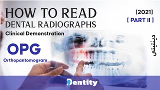 كيف تقرأ اشعة الأسنان البانورامية [OPG Interpretation ]