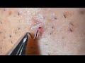 Plucking facial hair & ingrown hair 1246 頬髭抜き(埋没毛あり)