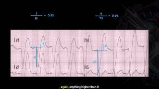 Understanding Smith Modified Sgarbossa Criteria - Good Reads