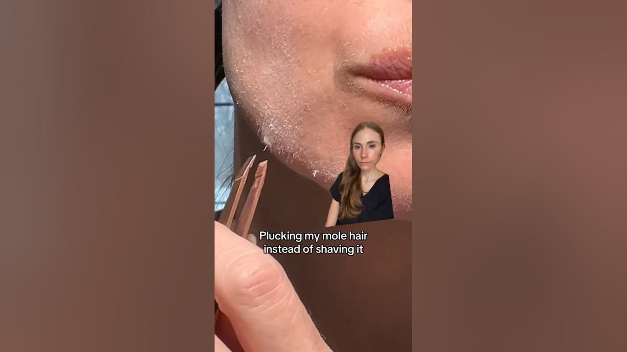 plucking-a-mole-hair-dermatologist-youtube