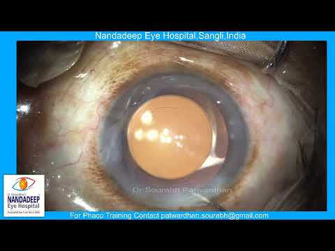 Nucleus prolapse and aspiration Dr Sourabh D Patwardhan demonstrates live cataract surgery