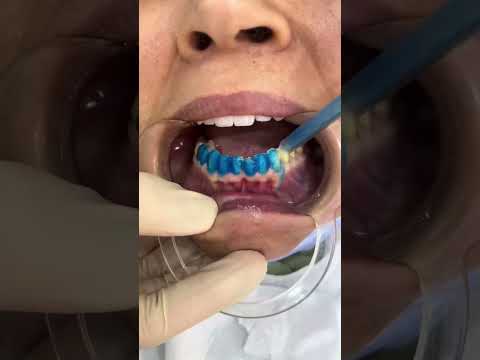 عدسات الفنيرز للأسنان بالكامل    اكسبلور الشعب الصيني ماله حل ترند  