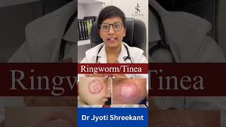 Ringworm Causes In Hindi