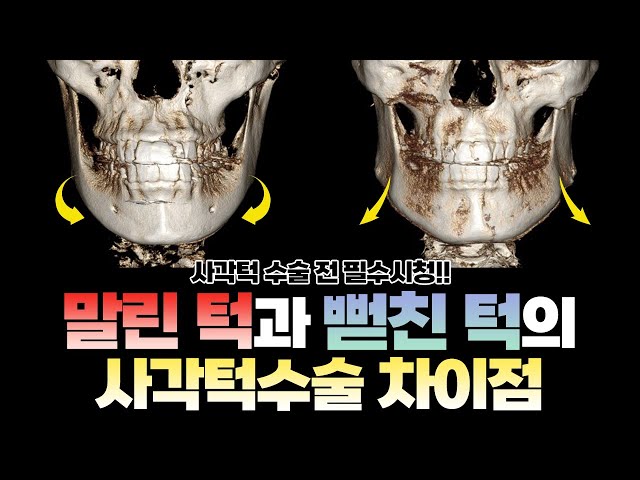 사각턱수술해도 효과없는 케이스, 수술전 필수시청!🔥