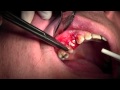 Extraction #5 with Socket Bone Grafting using d-PTFE, Suturing Technique