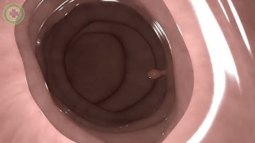 Nội soi cắt polyp đại tràng | 3D Animation