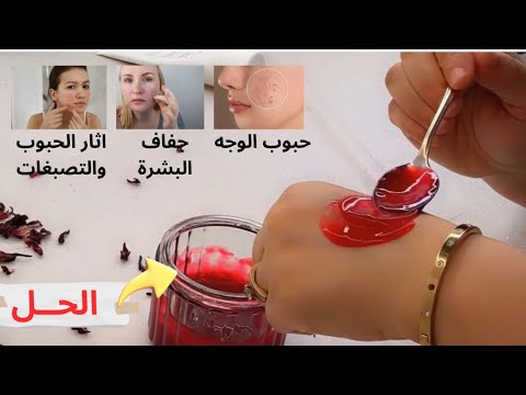 ماسك الكركدية والنشا للقضاء على حب الشباب والتصبغات لتصفية البشرة وتوريد الخدود