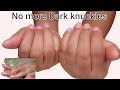 How to fade away dark knuckles fast//DIY clear dark knuckles at home.