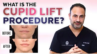What Is The Cupid Lift Procedure?