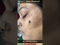 Cheek Mole Removal with Laser 👩‍⚕️