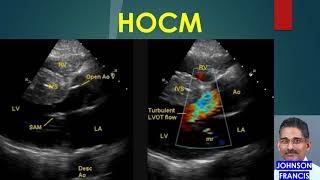 HOCM - Hypertrophic Obstructive Cardiomyopathy