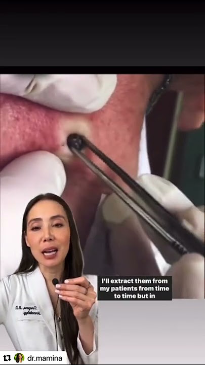 Duet with Dr. Pimple Popper: Blackhead extraction