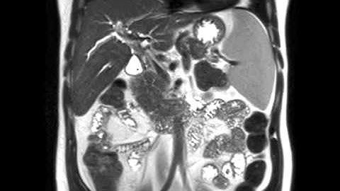Primary Sclerosing Cholangitis (PSC)