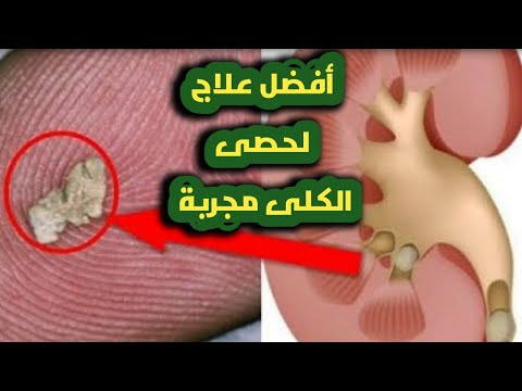 أفضل وصفة مجربة لعلاج حصى الكلى لخبير الأعشاب حسن خليفة سوف تدهشك النتيجة