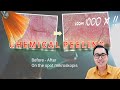 Zoom 1000x Pasca Peeling, Pantes Aja Glowing! | Before-After Chemical Peeling dr. Irfan Prasetya