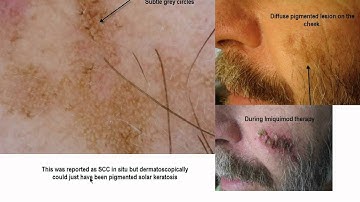 Dermoscopy Made Simple - SCC in situ and Pigmented Bowen