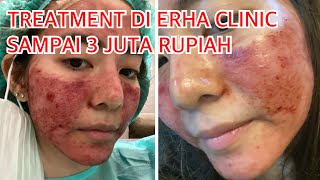 DERMAPEN DI ERHA CLINIC SEHARGA 3 JUTA!! GIMANA YA HASILNYA?