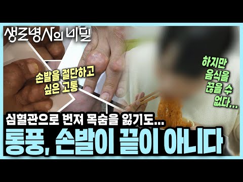 [본방 종합] 10년 새 남성 통풍환자 82% 증가! '통증의 왕', 이제 당신의 심혈관까지 위협한다 I KBS 250827 방송