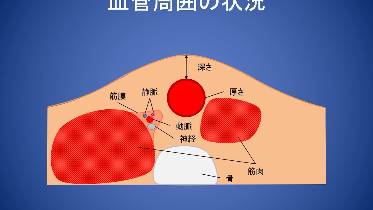 エコーガイド下穿刺動画マニュアル エコー下穿刺における各種穿刺法の使い分け 第一法と第二法 実技 看護師 平山遼一 撮影 編集 It推進部 花田真一 解説 監修 院長 下池英明 Youtube