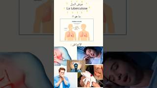 اشتركوا في القناة?.مرض السل tuberculoseshorts medicalstudent