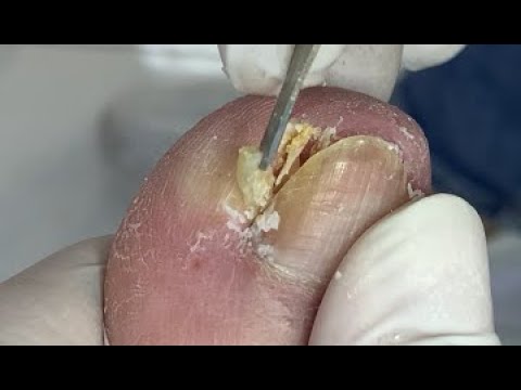 Video: Keratolytic neutralizer for heels and cuticle remover pH restoration and skin hydration, SKINTERRIA