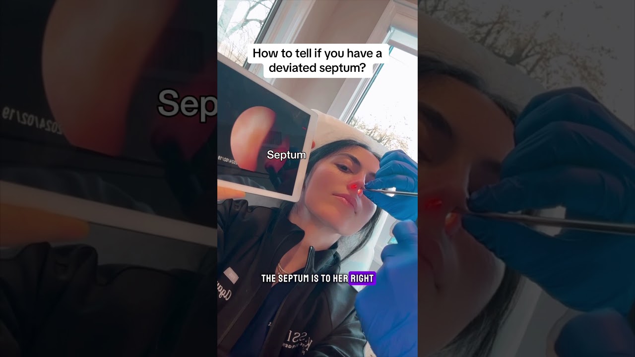 Как определить, искривлена ​​ли у вас носовая перегородка? #искривленнаяносоваяперегородка #септо...
