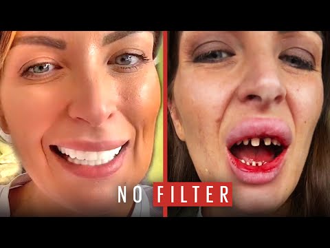 The Horrible Truth Behind My 'Turkey Teeth' | No Filter | Ladbible