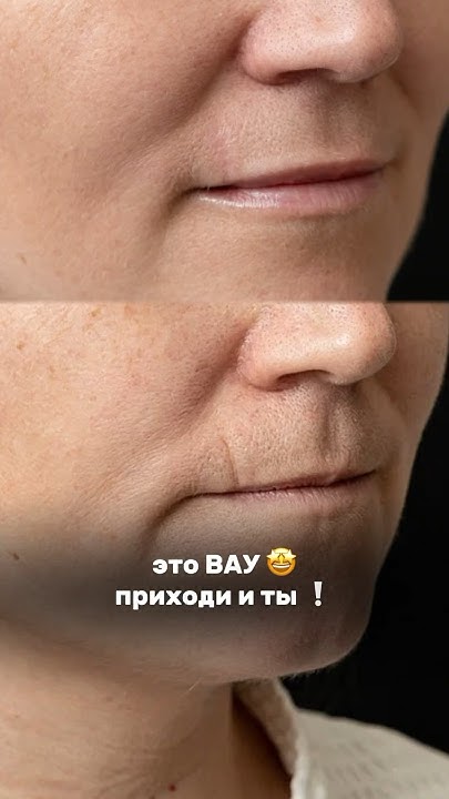 Как избавиться от шрама? - YouTube