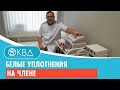 😕 Белые уплотнения на члене. Клинический случай №785