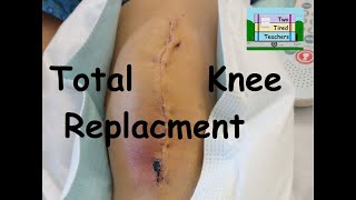 Total Knee Replacement by Two Tired Teachers 951 views 6 days ago 4 minutes, 54 seconds