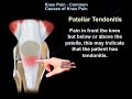 Knee Pain - Everything You Need To Know - Dr. Nabil Ebraheim